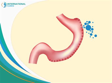 signs of gastric sleeve leak|Gastric Sleeve Leak Symptoms: Know the signs before its too late